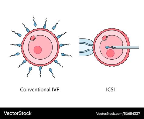 IVF és ICSI eljárások összehasonlítása