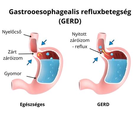 A nyelőcső alsó záró izmának (LES) működése és a reflux kialakulása