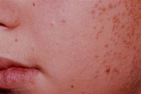 Az ótvar (impetigo) tünetei a gyermek arcán