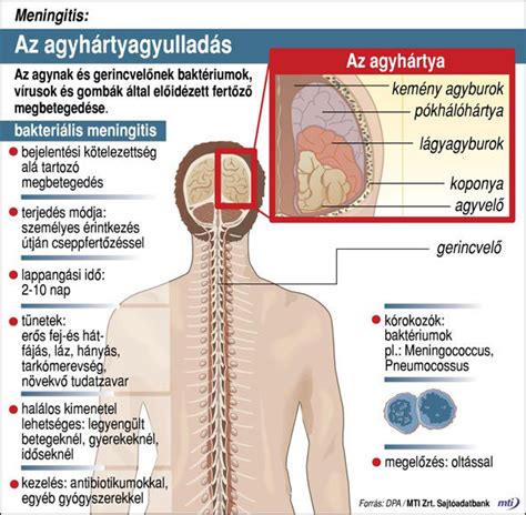 agyhártyagyulladás tünetei gyermekeknél