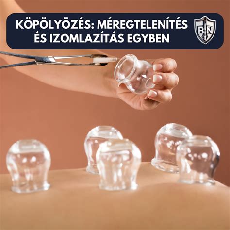 Köpölyözés technikája