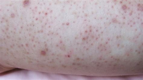 Keratosis pilaris tünetei a bőrön