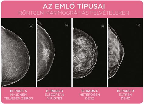 Női emlő ultrahang és mammográfia