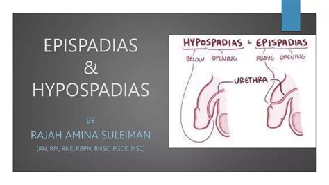 Hypospadiasis és epispadiasis