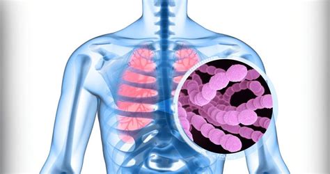 A pneumococcus baktérium okozta betegségek