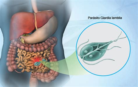 A giardiasis főbb tünetei infographic