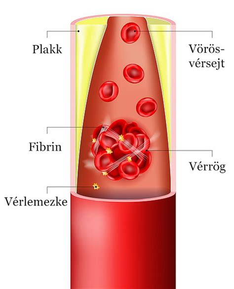 Vérrögök a vérerekben
