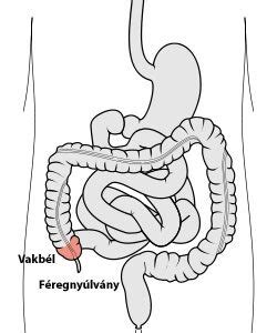 Infografika a vakbélgyulladás gyermekeknél jelentkező tüneteiről
