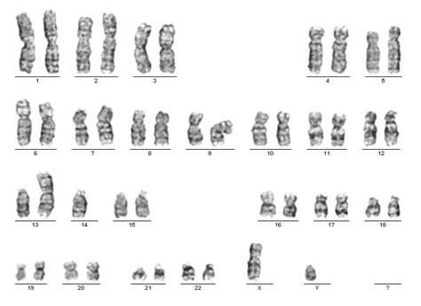 A Down-szindróma genetikai háttere