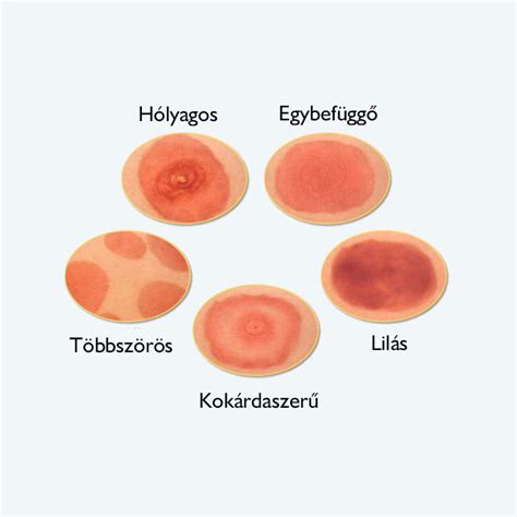 Lyme-kór tünetei és kullancs terjesztése