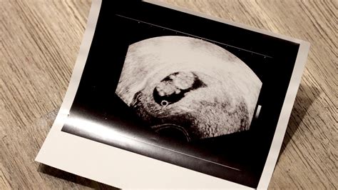 illusztráció méhen kívüli terhességről a petevezetékben
