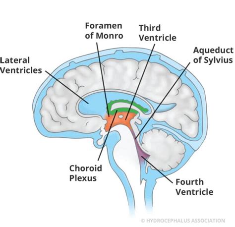 Ultrahang felvétel choroid plexus cisztáról