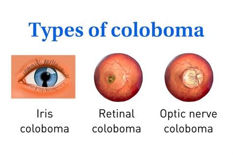 Veleszületett iris coloboma