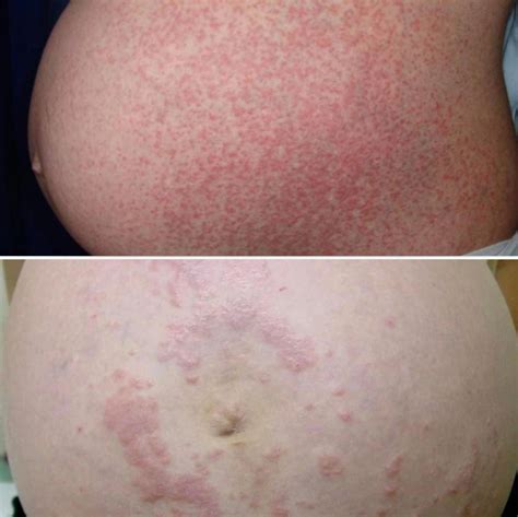 Terhességi dermatosisok: PUPPP és Herpes Gestationis