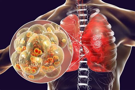Aspirációs pneumonia röntgenképe