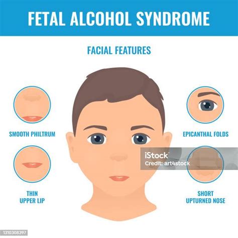 A magzati alkohol szindróma jellegzetes arcvonásai