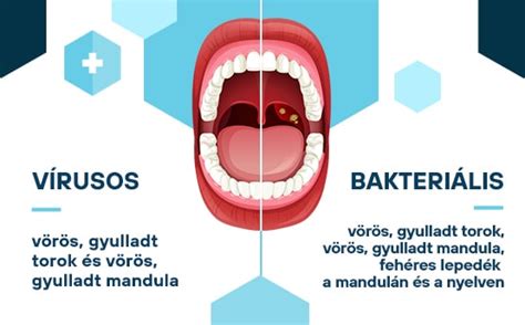 Torokgyulladás és tünetei