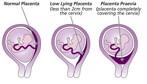 A placenta praevia különböző típusai