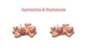 Születési rendellenesség: gastroschisis