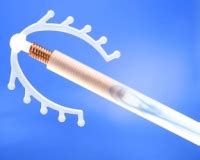 Méhen belüli fogamzásgátló eszközök (spirálok)