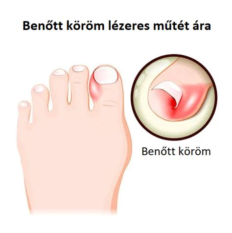 A benőtt köröm helyes vágása