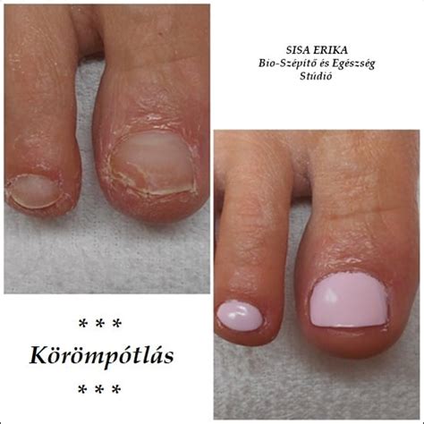 Fellevegősödött köröm