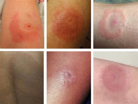 Kullancscsípés és erythema migrans