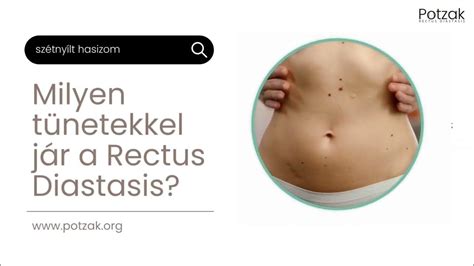 A szétnyílt hasizom (diastasis recti) otthoni önvizsgálata