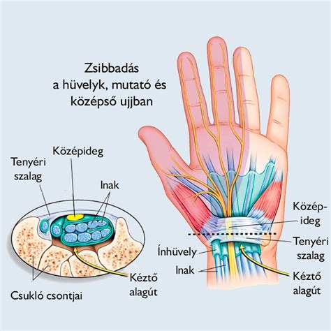 Kéz és ujjak zsibbadása a carpalis alagút szindróma esetén