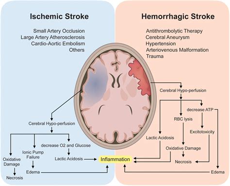 A stroke típusainak ábrája