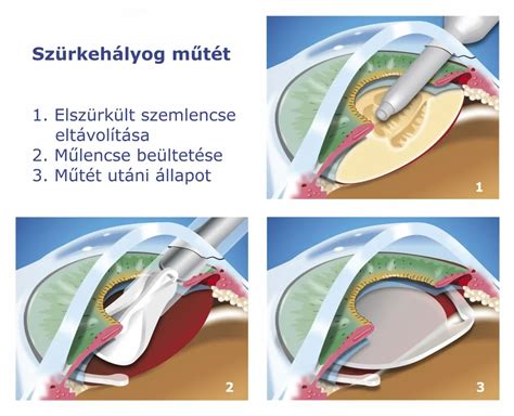 Missed ab műtét utáni teendők listája