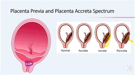 A placenta accreta és previa típusai