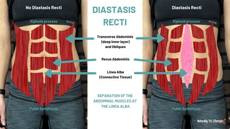 Diastasis recti - hasizom szétválás