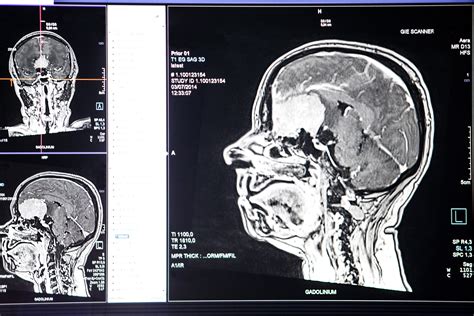 MRI felvétel az agyról