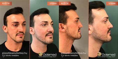Alakkorrekciós műtét előtte-utána
