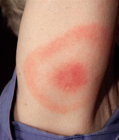 Lyme-kórra jellemző bőrpír (erythema migrans)