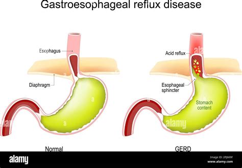 gyomor-nyelőcső reflux diagram