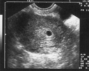 Ultrahangos kép 6 hetes terhességről, ahol csak a petezsák látszik