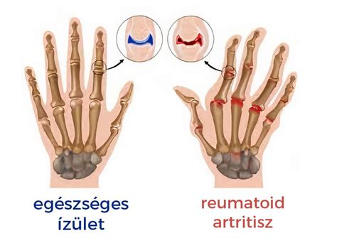 Az ízületi gyulladás tüneteinek szemléltetése gyermekeknél