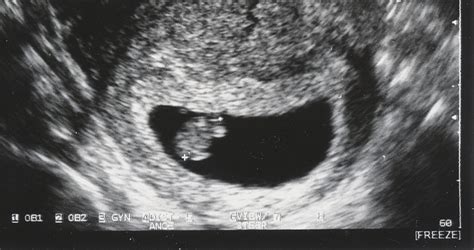 A terhesség hetei és az abortusz határidejei