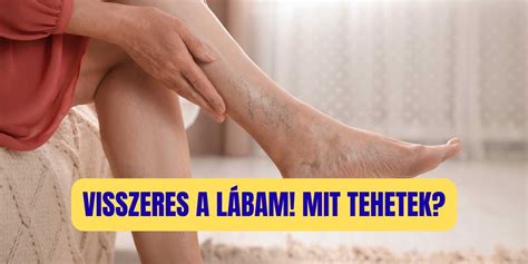 Visszeres tünetek a lábon