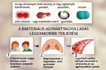 A bakteriális agyhártyagyulladás leggyakoribb kórokozói