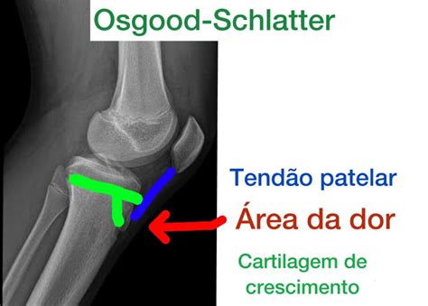 A Schlatter-Osgood szindróma anatómiai ábrája