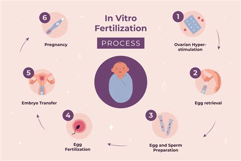 In vitro fertilizáció (IVF) folyamatát ábrázoló infografika