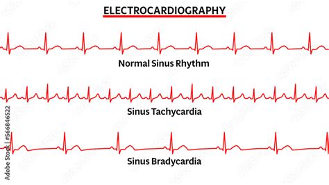 Tachycardia és bradycardia összehasonlítása
