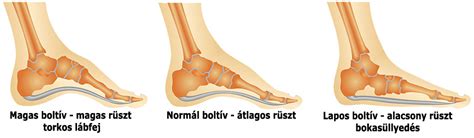 Magas rüsztű gyermekláb cipőválasztási tippek