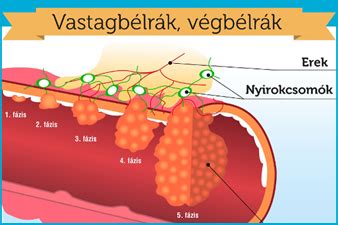 A végbélsérv tünetei infografika