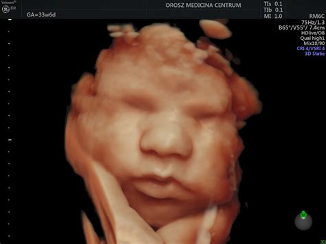 Babamozi ultrahang: 3D/4D képek a magzatról