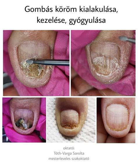 A gombás köröm különböző tünetei