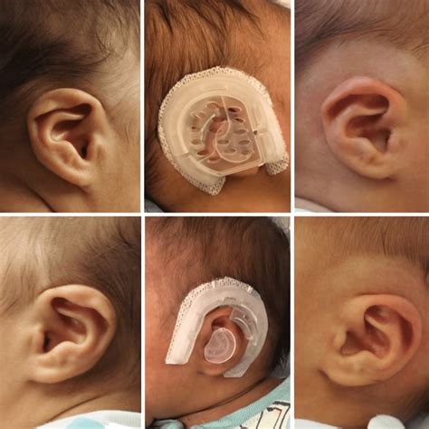 Ear molding eljárás